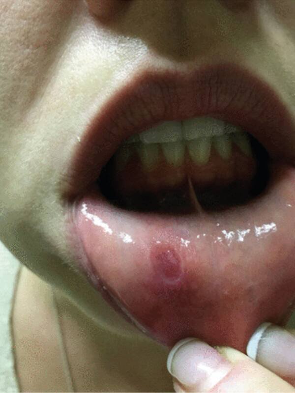 Syphilis