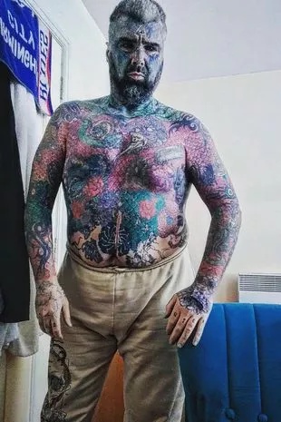 The man, now named Body Art, will now have to undergo a few corrective procedures from implants he received years ago