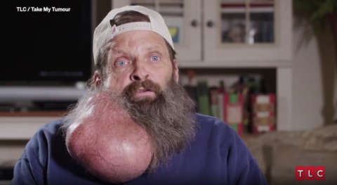 Take My Tumor, TIm