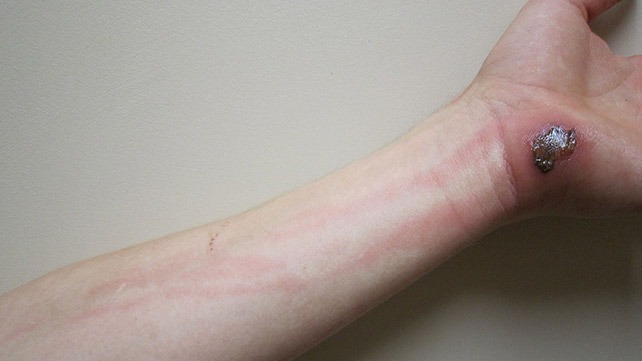 Skin Infection: Pictures, Causes and Treatments