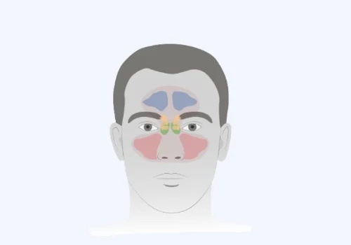 Foods to Avoid with Sinus Infection
