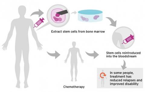 New study shows long term promise of stem cell therapy for MS | Multiple  Sclerosis Society UK