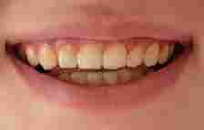 How to Remove Persistent Teeth Yellowing Despite Brushing: Tried and Tested Tips