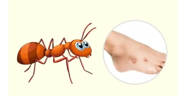 10 Bug Bites Anyone Should Be Able To Identify Viral Wow