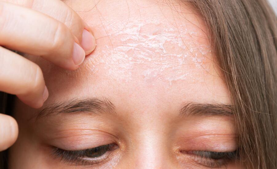 Dry Flaky Skin Off the Face