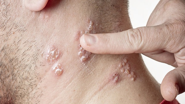 Skin Infection: Pictures, Causes and Treatments