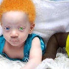 Incredible Story of Black Twins with Different Colors Revealed!
