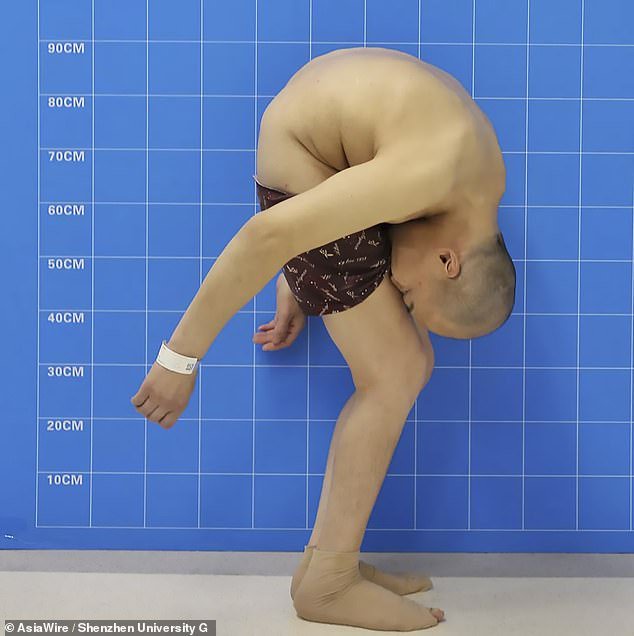 Li Hua, 46, was dubbed the 'folding man' (pictured) due to his condition, ankylosing spondylitis, which was diagnosed in 1991 at the age of 18