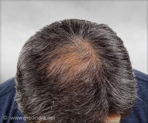 What Causes Baldness and Gray Hair?