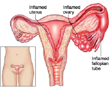 Here Are The Signs And Causes Of Blocked Womb For Women 7b9f1a3dd67a4516b0e6bd0f7329c415 quality uhq format webp resize 720