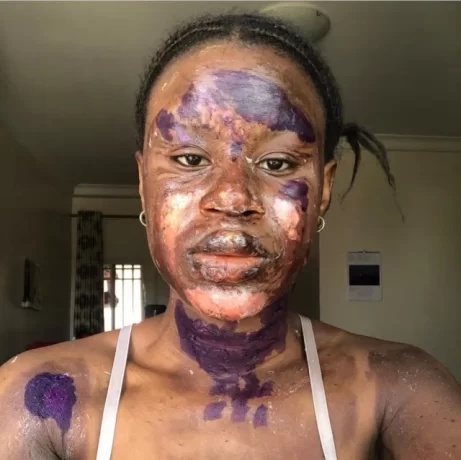 "I Never underwent any Surgery"- Burn writes as shows off her amazing transformation as skin heals without blemish; Reveals what she used(photos)
