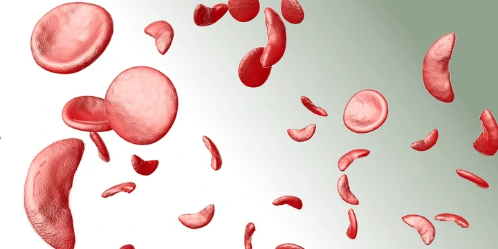 NaTHNaC - Sickle cell disease and thalassaemia