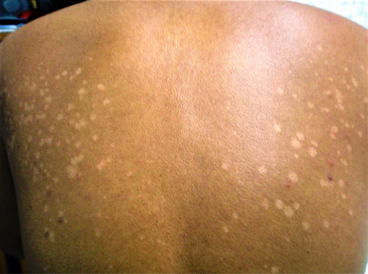 Tinea Versicolor - Causes, Signs, Symptoms, Treatment &amp; Remedies