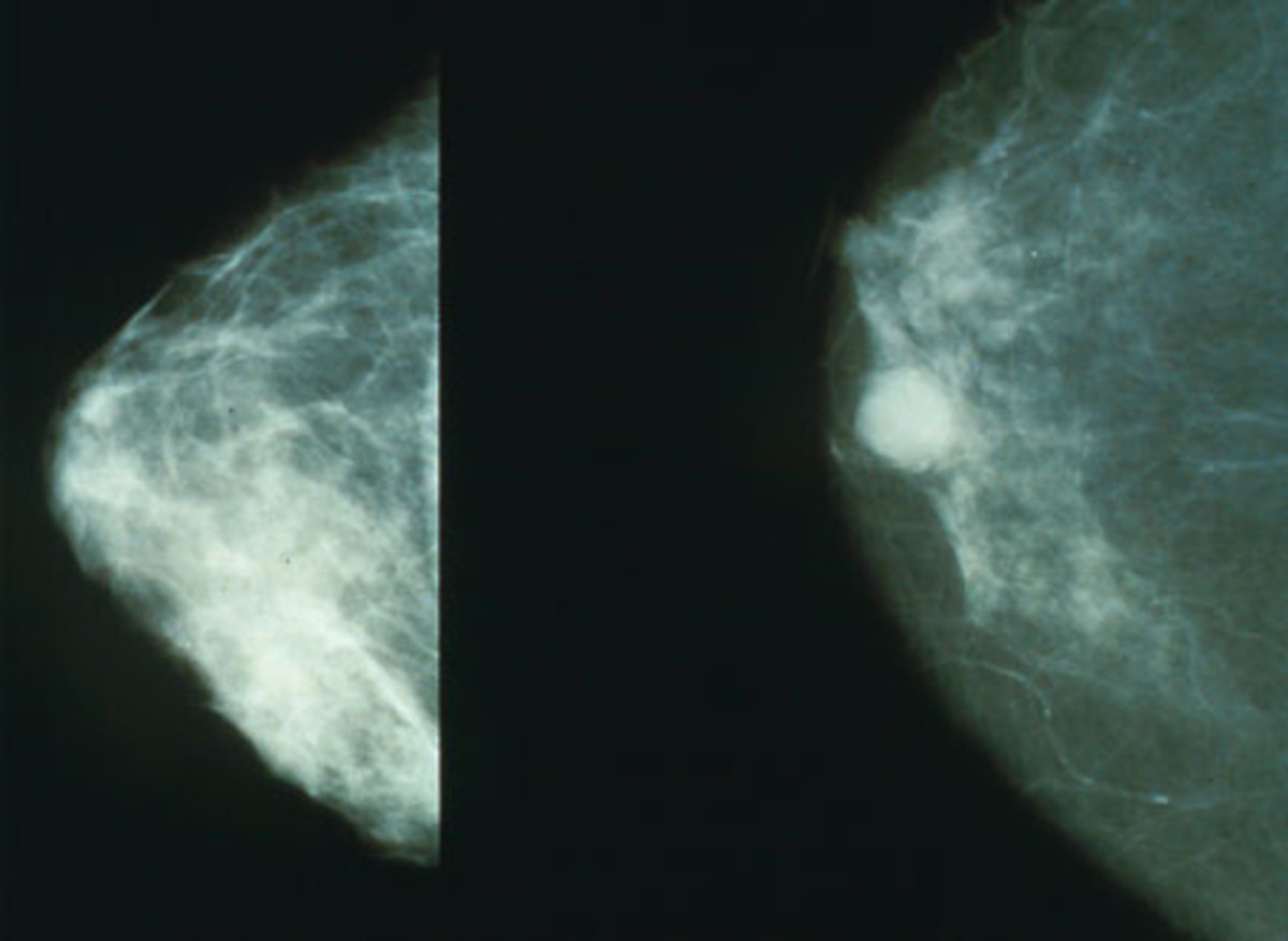 Mammography of breast cancer