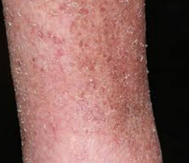 4 Causes Of Itching After Bathing And How You Can Prevent It Opera News