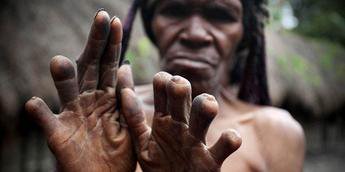 The finger-cutting as a mourning practice of the Dani People [Guardian]