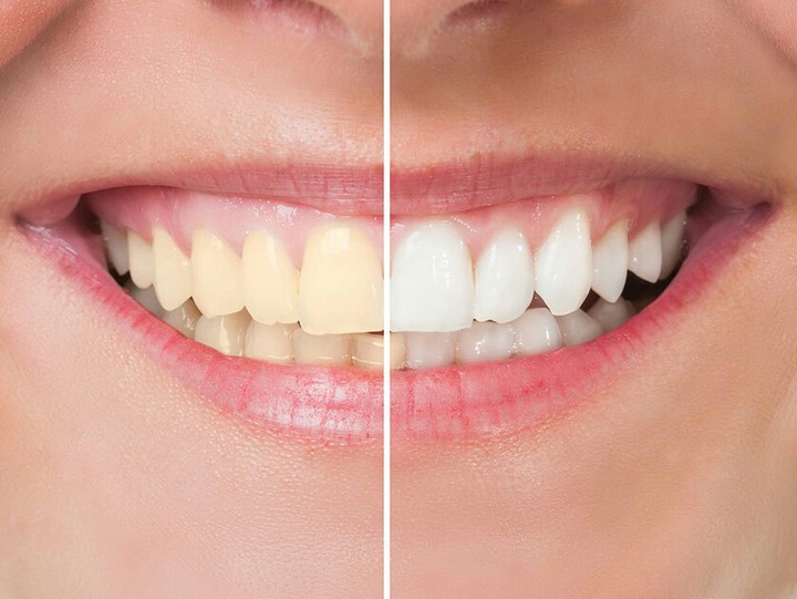 How To Whiten Your Teeth With Salt And Warm Water Opera News