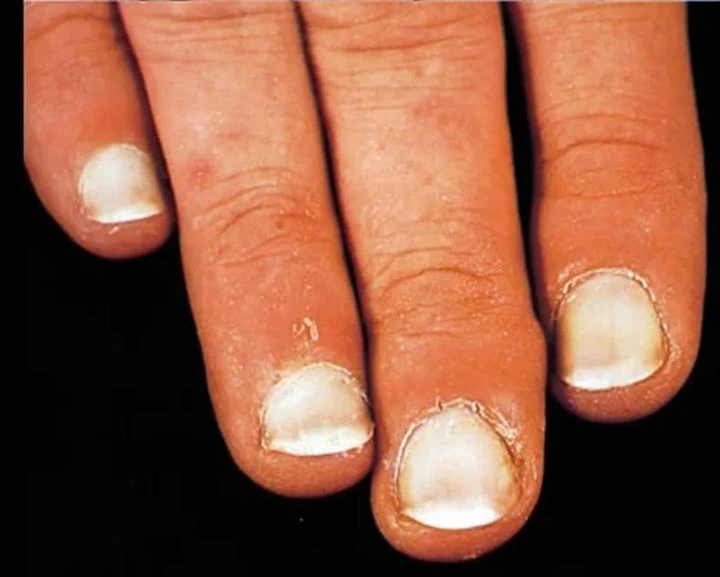 Leukonychia or white nails [healthjade]