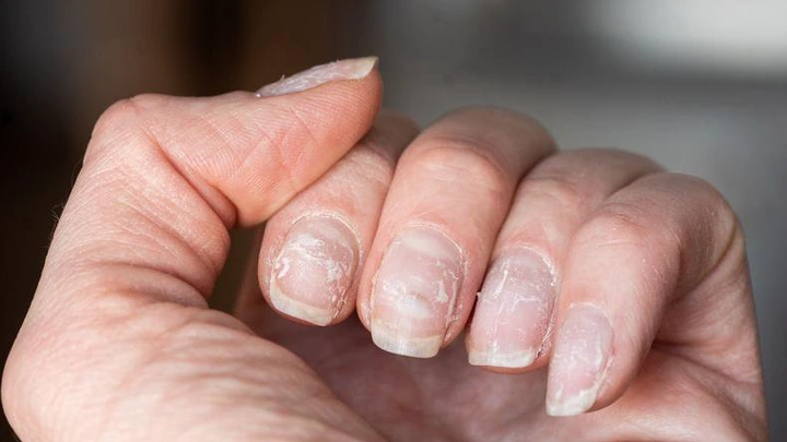 Cracked nails [prevention]