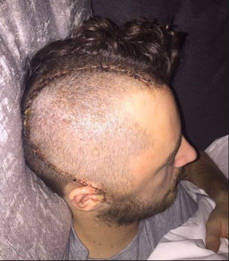 Ryan Mason had to have 50 staples in his head after the horror collision