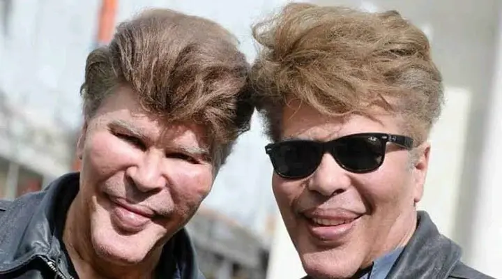 These Twin Brothers Changed Their Faces With Plastic Surgery, They Looked Before (See Photos)