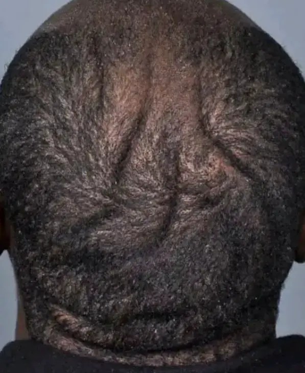 Here Reason Some People Have Wrinkles Their Head