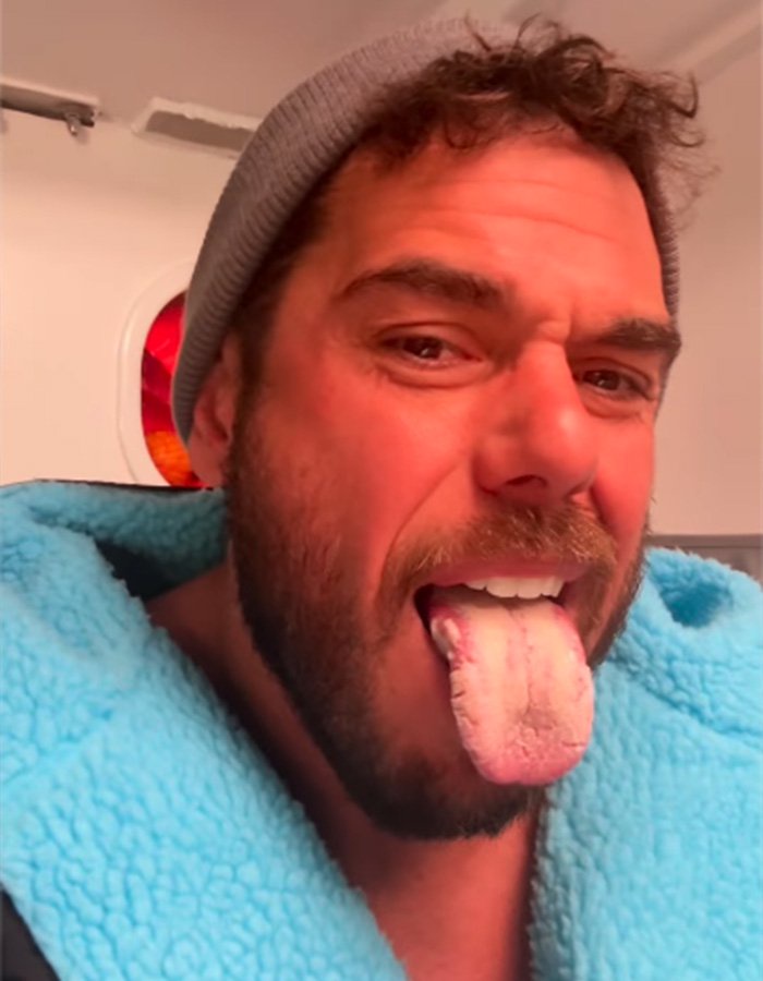 Extreme swimmer showing his swollen and discolored tongue caused by salt water exposure during an ocean swim