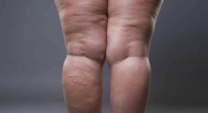 How to get rid of cellulite(inquisitr)