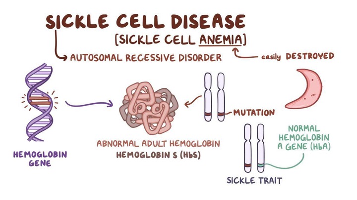 Sickle cell disease: Clinical practice | Osmosis