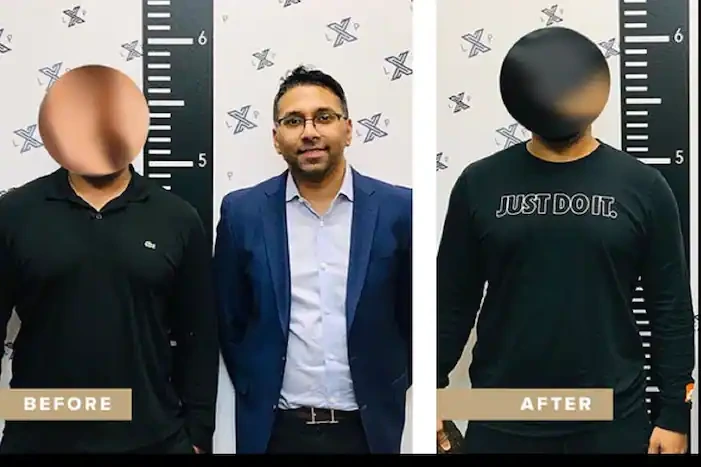 Craze To Grow Taller In American Men; Surgical Process Can Increase Height By Up To 6 Inches Craze To Grow Taller In American Men; Surgical Process Can Increase Height By Up To 6 Inches