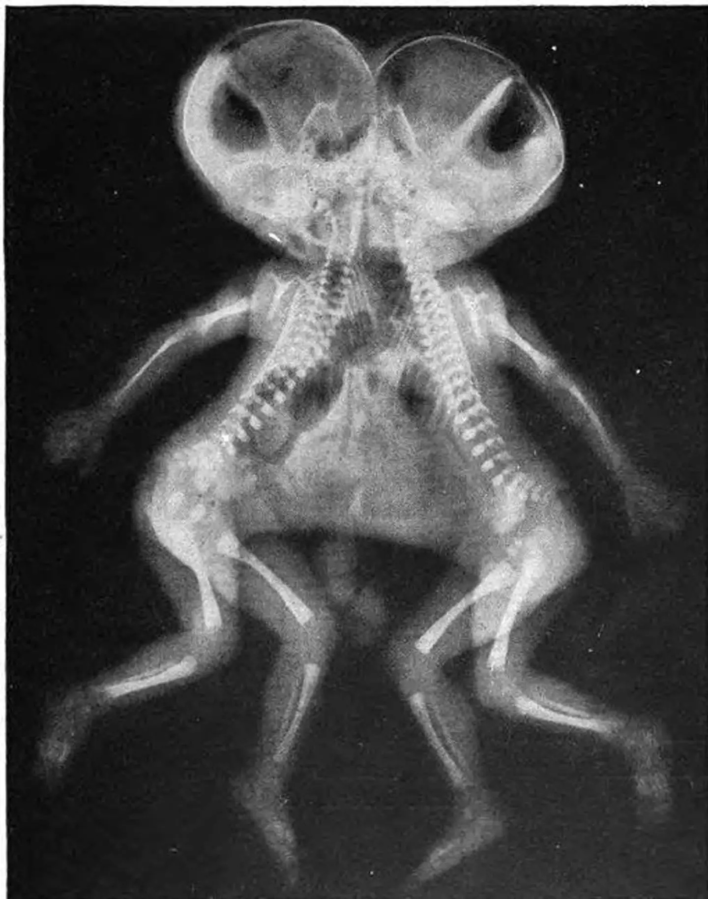 Conjoined twins often feel each other's pain, literally. (Mae M. Bookmiller/Wikimedia Commons/Public Domain)