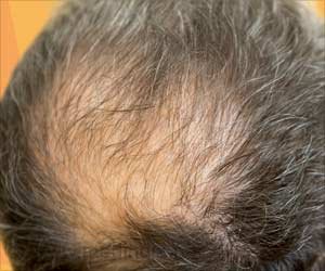 Baldness and Premature Graying in Men: Risk of Heart Disease