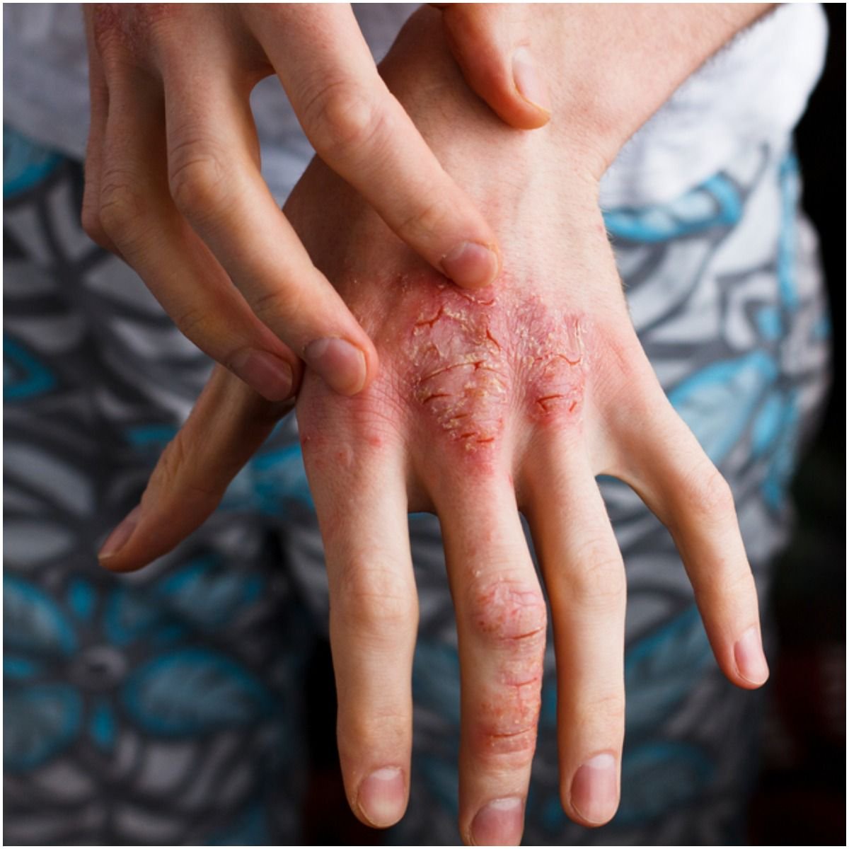skin Atopic Dermatitis and skin itching