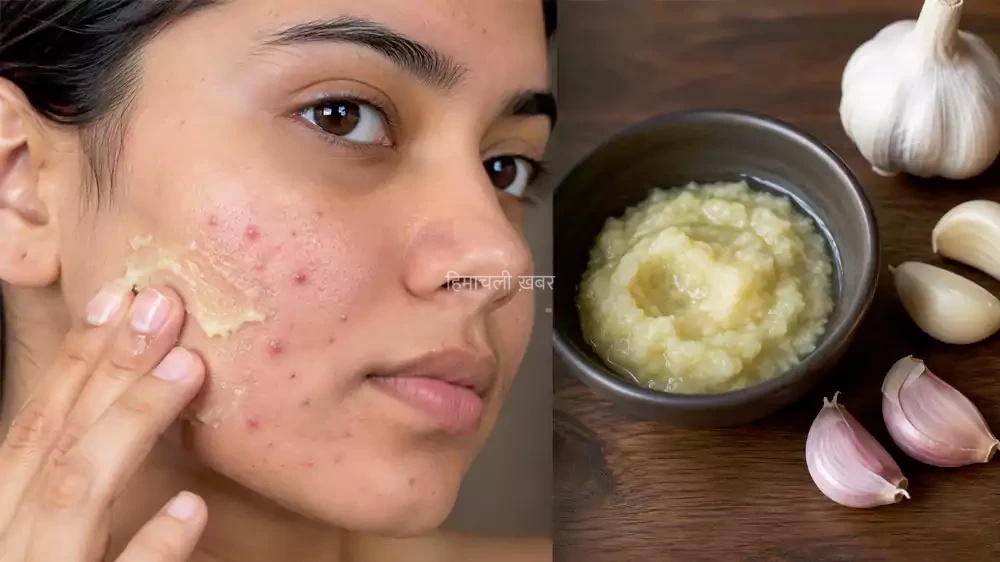 lahsun pimple