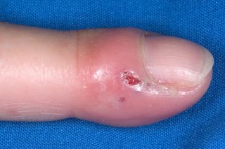 A finger, red and swollen around the fingertip with a small blister at the side of the nail