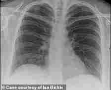 The image shows a scan of healthy lungs without the glass opacities that indicate lung damage