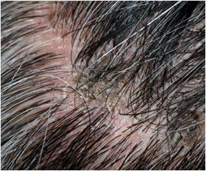 Premature Graying