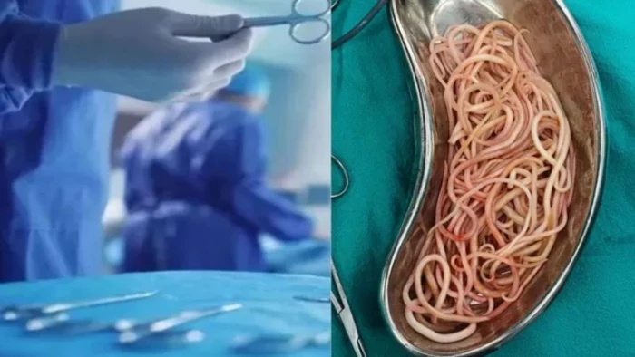 बच्ची के पेट में सैकड़ों कीड़े देख डॉक्टर भी रह गए हैरान, सर्जरी से बची जान, पेरेंट्स को चेतावनी