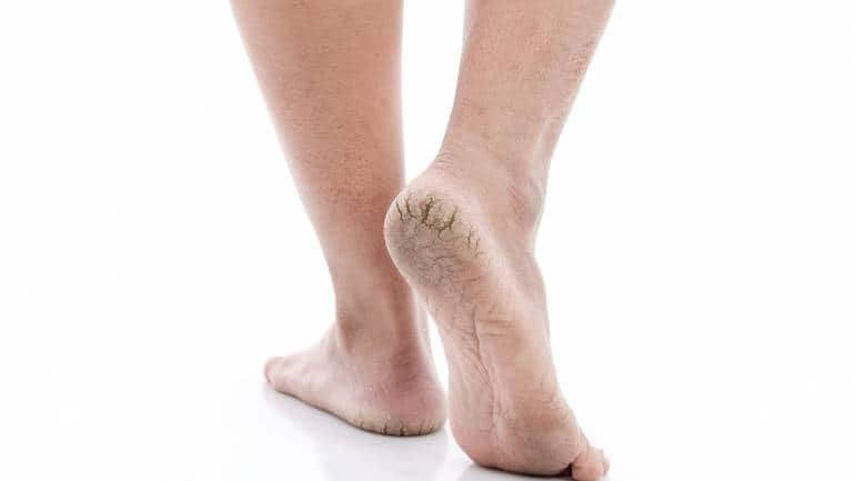 With summer's heat and increased exposure to outdoor elements, your heels require extra attention to stay soft, smooth, and free of discomfort. Try these 7 ingredients to help heal dry skin and cracked heels (Image: Canva)