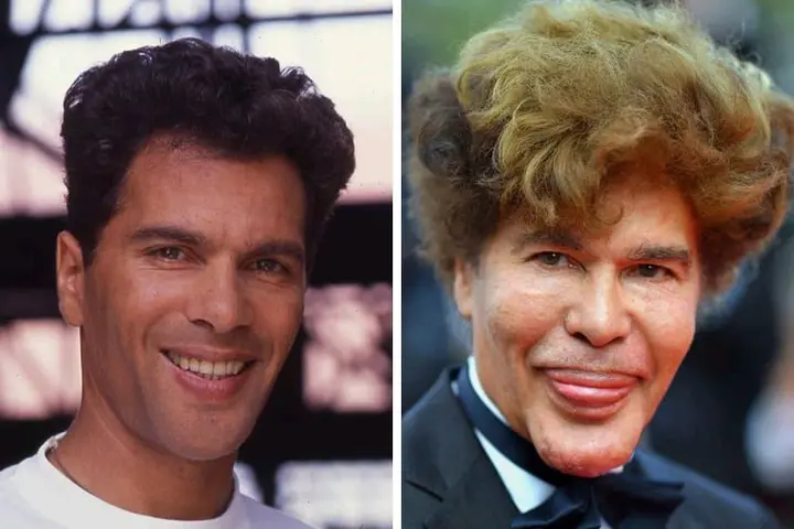 These Twin Brothers Changed Their Faces With Plastic Surgery, They Looked Before (See Photos)