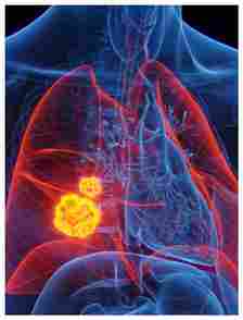 Lung Cancer: Know the Signs, causes, symptoms, and early detection RBA