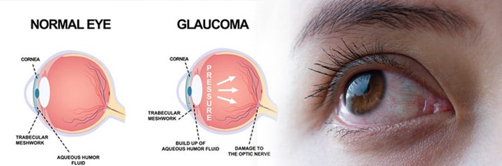 Glaucoma - Ananthaksha Super Speciality Eye Hospital | Nelamangala