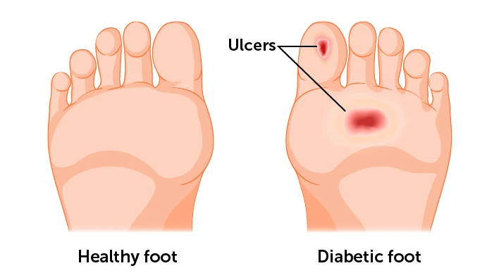 foot infection