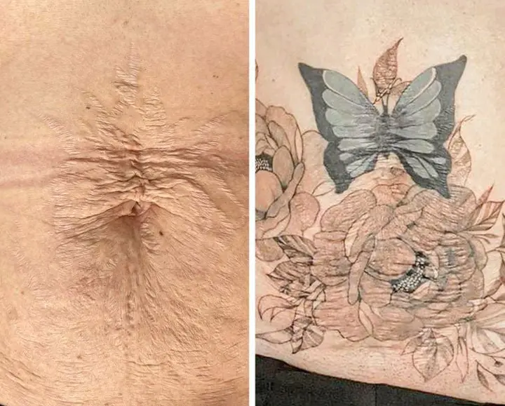 Transformation Twenty-Two Scars Into Beatify Tattoos