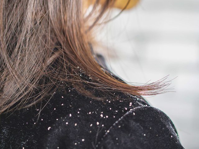 Treat Dandruff, Homemade anti dandruff hair mask, DIY anti dandruff hair pack, Home remedies to cure dandruff, DIY remedies to prevent dandruff