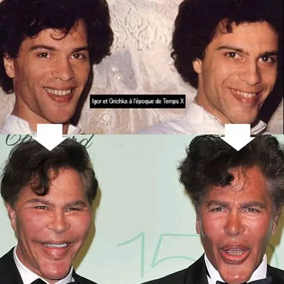 These Twin Brothers Changed Their Faces With Plastic Surgery, They Looked Before (See Photos)