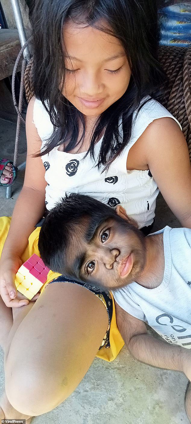 The toddler's two other siblings were all born healthy, Jaren is the only one who was born with the rare condition