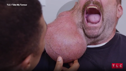 Take My Tumor, TIm