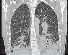 The scan of the patient's lungs reveal semi-opaque spots that doctors initially confused for signs of bacterial pneumonia