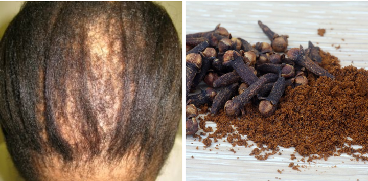 Did you know that Cloves(Pepre) helps prevent hair loss? Check out more